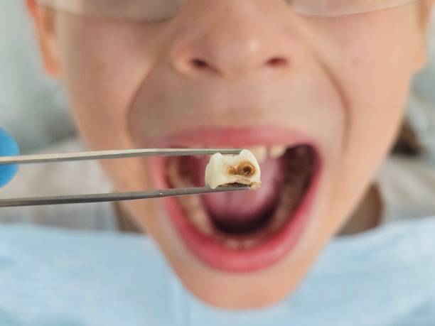 Best Emergency Treatment for Toothache in Stanwood, WA